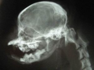 下頜骨脫位 下頜骨脫位