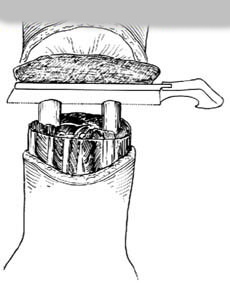 前臂截肢術 前臂截肢術