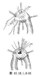 營養性空腸造口術 營養性空腸造口術