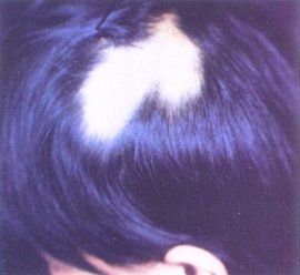 兒童斑禿 兒童斑禿