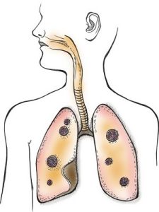 急性呼吸窘迫綜合徵 急性呼吸窘迫綜合徵
