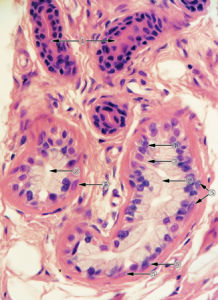 化膿性汗腺炎 化膿性汗腺炎