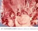 勒夫勒心內膜炎 勒夫勒心內膜炎