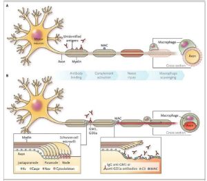 格林-巴利綜合徵 格林-巴利綜合徵