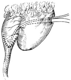 慢性反流性腎病
