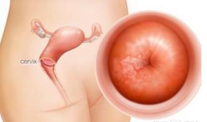 宮頸糜爛1度