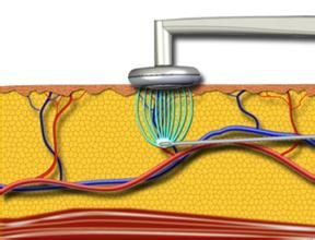 射頻溶脂 射頻溶脂