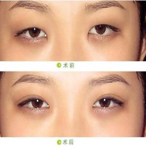 開外眼角 開外眼角