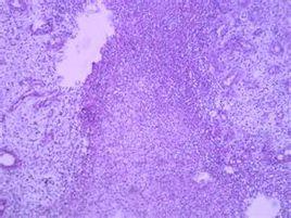 郎罕巨細胞 郎罕巨細胞