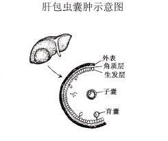 肝包蟲囊腫 肝包蟲囊腫