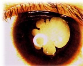 並發性白內障 並發性白內障