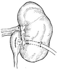 膀胱-輸尿管反流綜合徵