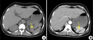 多脾綜合徵 多脾綜合徵