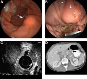 胰腺異位 胰腺異位