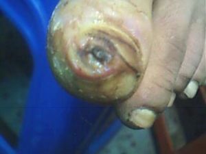 膿性指頭炎 膿性指頭炎