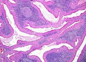 腺淋巴瘤 腺淋巴瘤