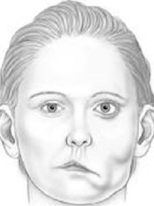 面癱後遺症 面癱後遺症