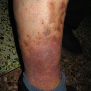 人為性皮炎 人為性皮炎