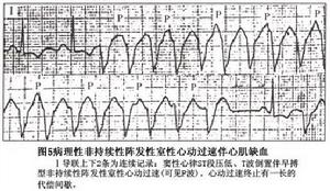 病理性陣發性室性心動過速