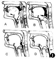 吞咽障礙 吞咽障礙