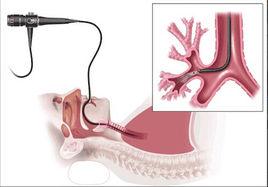 支氣管熱成形術 支氣管熱成形術
