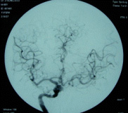 （圖）腦內動脈瘤