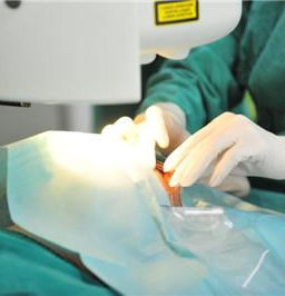 近視矯正手術 近視矯正手術