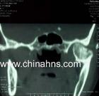 顳下頜關節急性前脫位