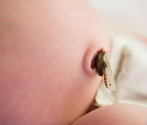 新生兒臍炎 新生兒臍炎