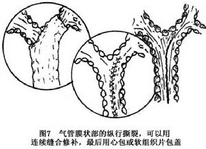 創傷性氣管及主支氣管損傷