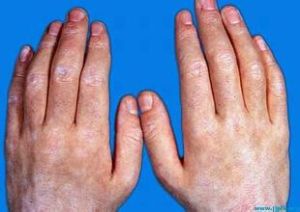 白細胞異常色素減退綜合徵 白細胞異常色素減退綜合徵