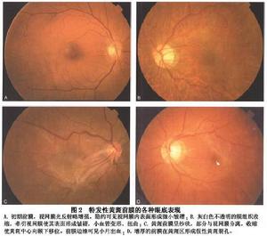 特發性黃斑部前膜