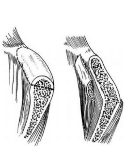同質移植 同質移植