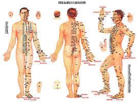 正弦調製中頻電療法 正弦調製中頻電療法