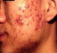 聚合性痤瘡