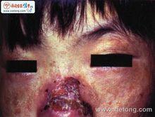 先天紅血球生成卟啉症