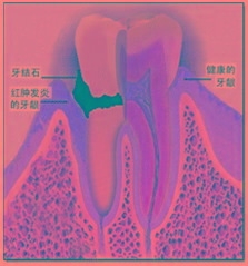成人牙周炎