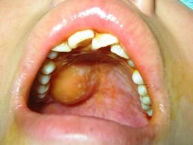 頜面部腫瘤 頜面部腫瘤