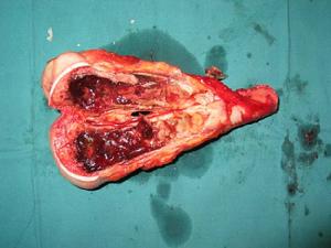 軟組織肉瘤