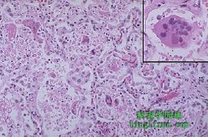 枸櫞酸桿菌肺炎