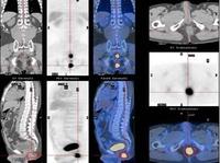 軟組織腫瘤 軟組織腫瘤