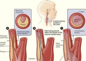 頸動脈支架植入術