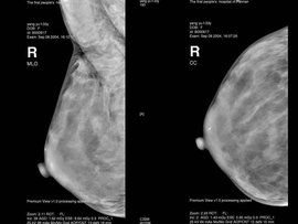 cooper韌帶 cooper韌帶