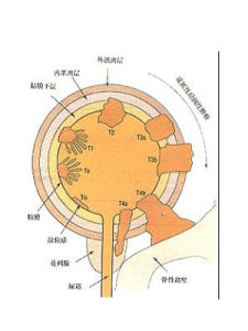 膀胱腫瘤 膀胱腫瘤