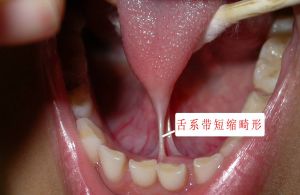 舌系帶畸形