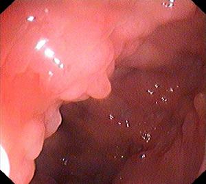 慢性非特異性潰瘍性結腸炎