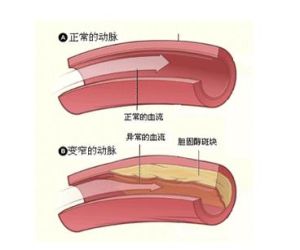 冠狀動脈狹窄 冠狀動脈狹窄