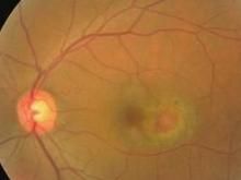 黃斑病變 黃斑病變