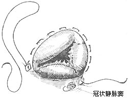 三尖瓣關閉不全