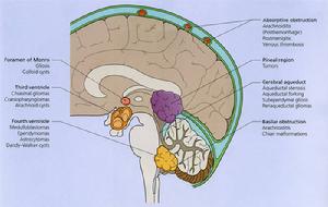高血壓腦病 高血壓腦病